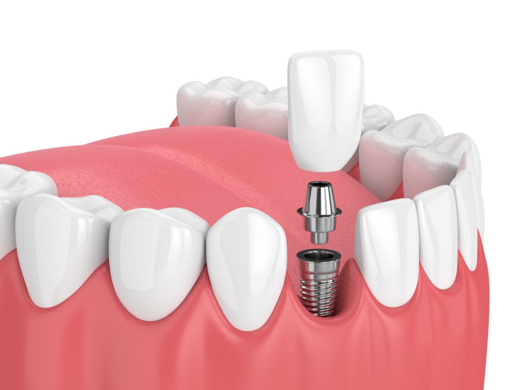 Implant Treatment in Timonium, Maryland