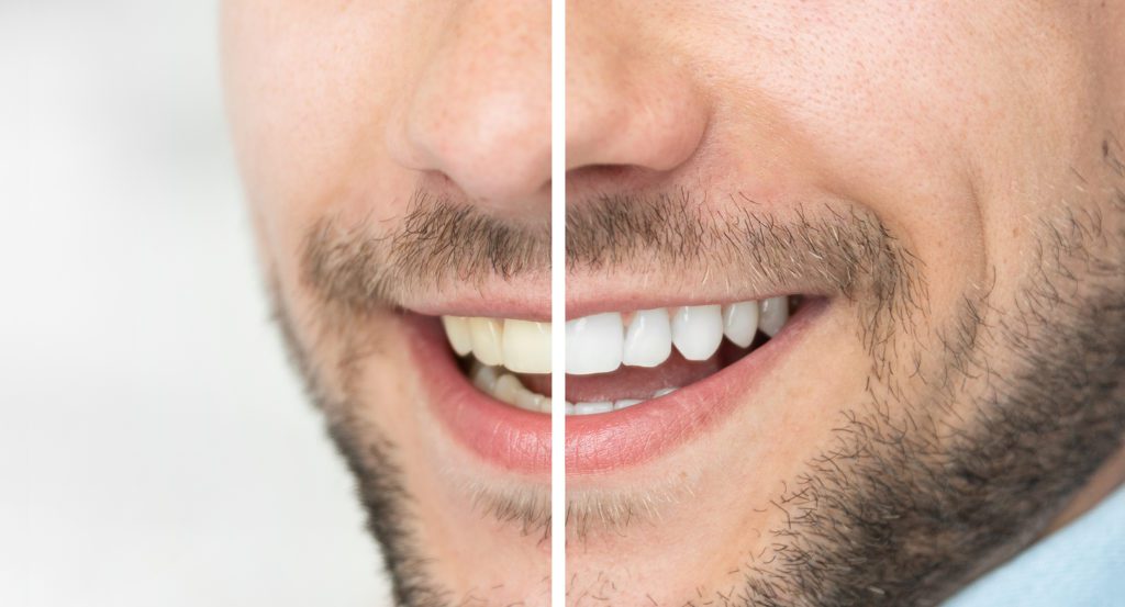 Treatment for Tooth Discoloration in Timonium, Maryland