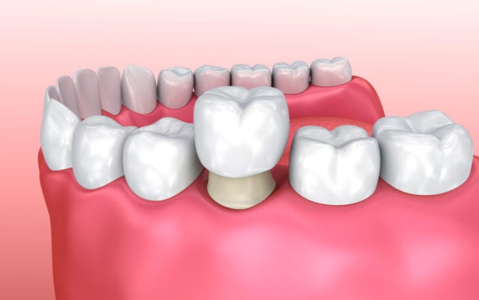 Dental Crown Treatment in Timonium, Maryland