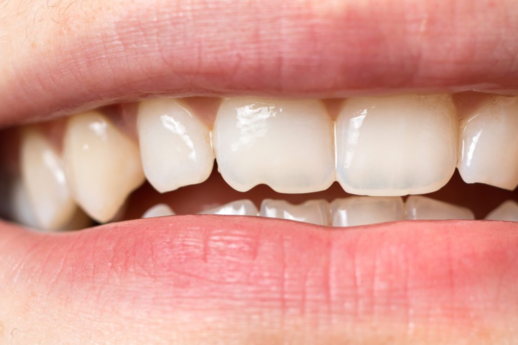 Tooth Damage in Timonium, Maryland