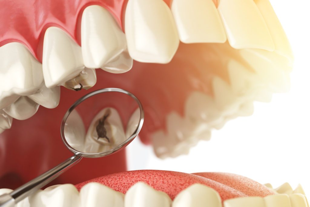 Treatment for Tooth Decay in Timonium, MD