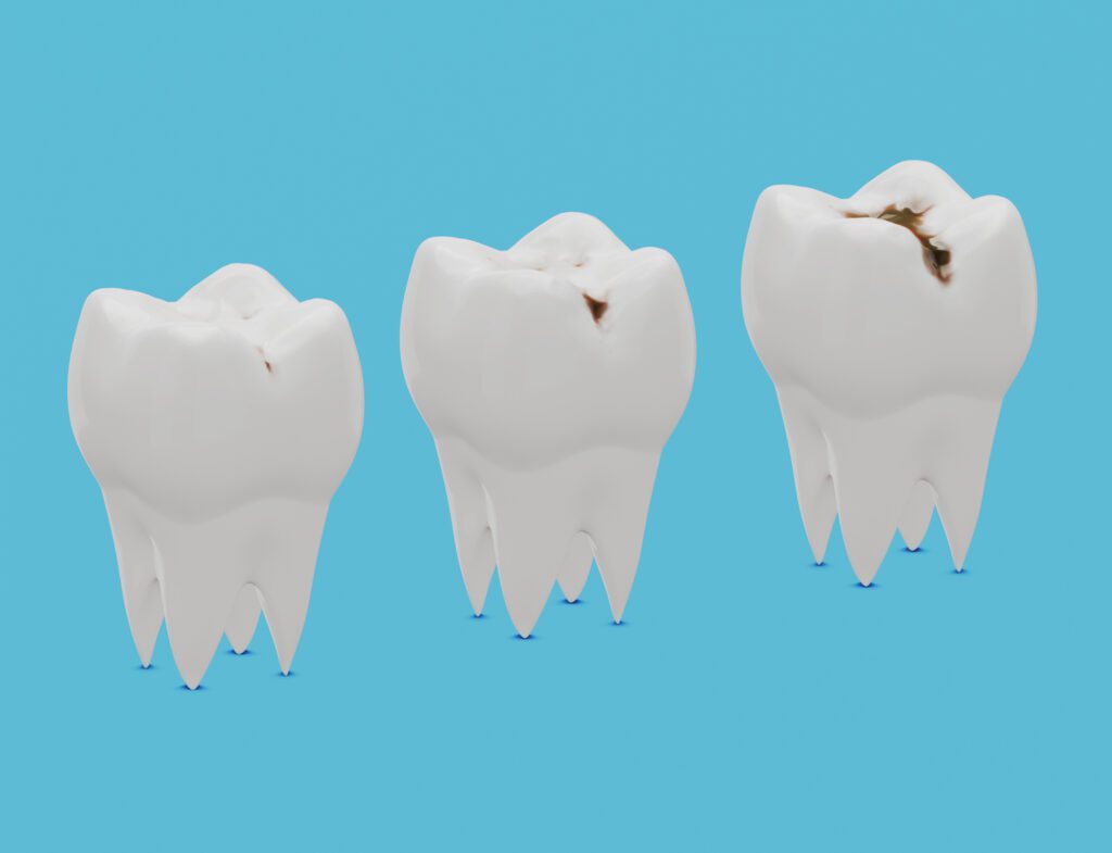 tooth cavities in timonium, maryland