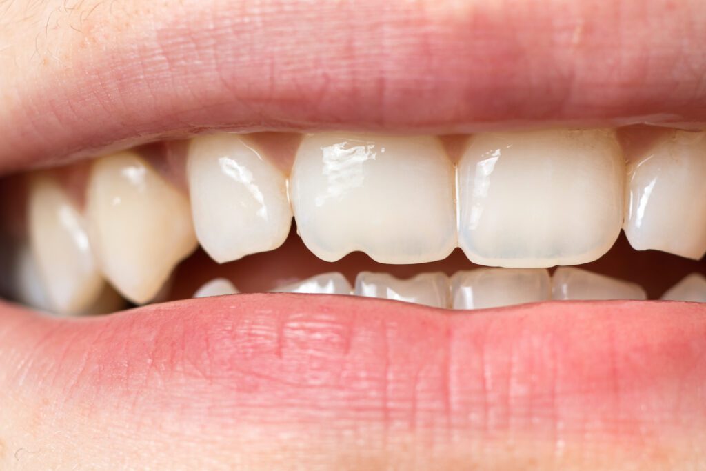 chipped teeth in timonium, maryland