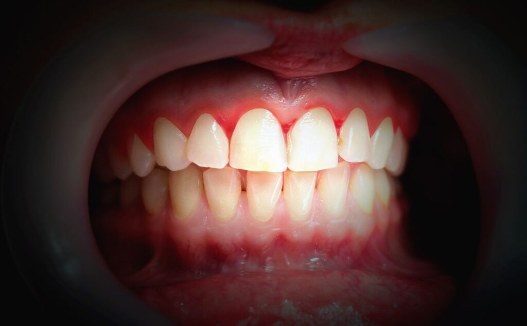 Mouth with bleeding gums on a dark background gum disease bleeding gums dentist in Timonium Maryland