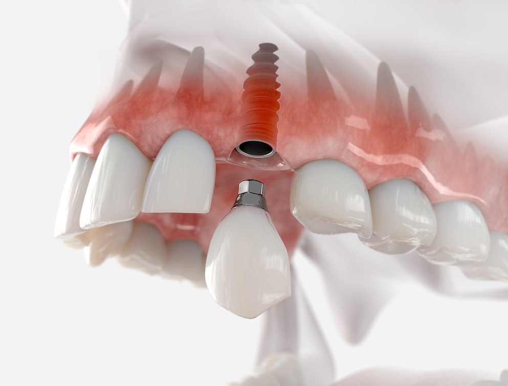 Dental implants can closely mimic the function of natural teeth, providing improved bite support and facial structure.